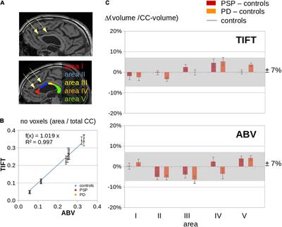 Segmental Alterations of the Corpus Callosum in Progressive Supranuclear Palsy: A <mark class="highlighted">Multiparametric Magnetic Resonance Imaging</mark> Study